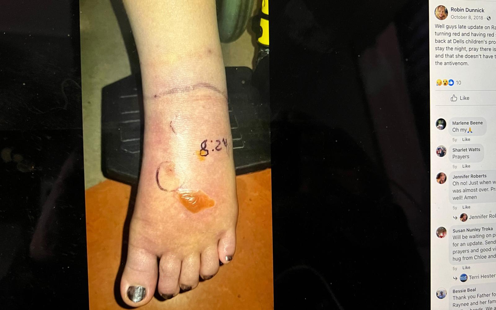 In this Oct 8, 2018 Facebook post, mom Robin Dunnick told her Facebook friends, "Well guys late update on Ray, her foot started turning red and having red spots so we are back at Dells children's probably gonna have to stay the night, pray there is no fang fragments and that she doesn't have to start all over with the antivenom."