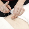 Dry Needling at Movement Therapy